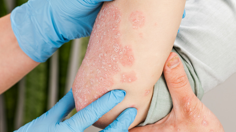 treatment for psoriasis